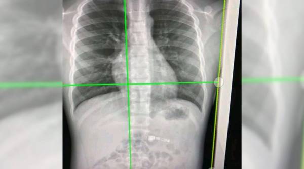 7 Year-old Boy Accidentally Swallows Apple Airpod; Gets Hospitalised 7 Year-old Boy Accidentally Swallows Apple Airpod; Gets Hospitalised